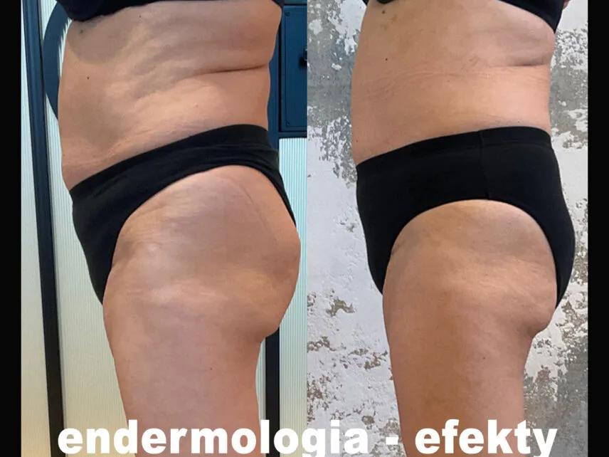 Efekty po zabiegach endermologii